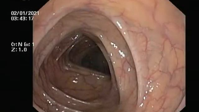 normal colonoscopy