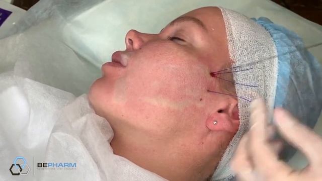 Мастер-класс имплантации спиральных нитей и нитей с насечками INTRARICH в одну процедуру.