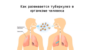 Взаимное влияние ВИЧ и ТБ