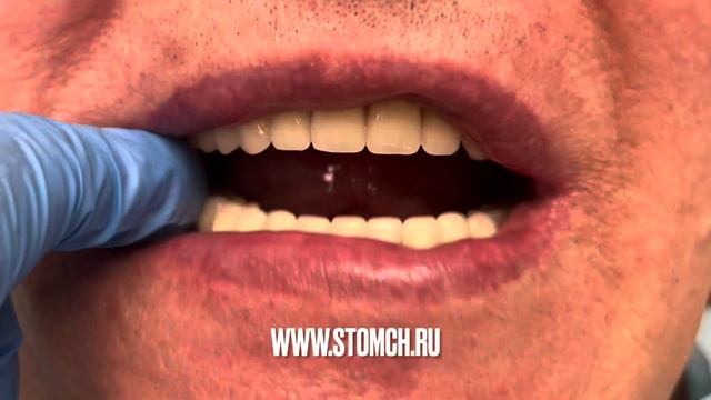 Протезирование полными съемными протезами в Липецке. Стоматология доктора Черных.