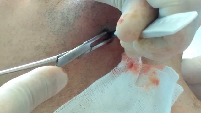 Pimple, Boil, Zit on Face. Выдавливание прыща на лице. смотреть онлайн