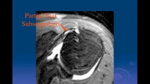 Biceps Tendon | Pt. 1