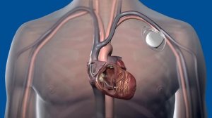 Аритмология Medtronic Дефибриллятор Defibrillator Принцип работы