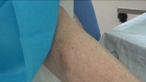 Блокада поясничного сплетения нейростимуляционная