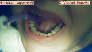 Фиксация металлокерамических коронок 33,43. Кейс #5.