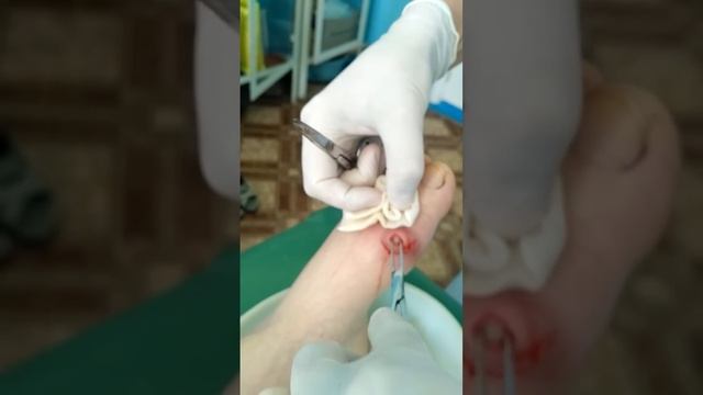 Pimple popping.gout.treatment.подагра.шишка на ноге.