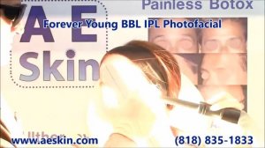 Forever Young BBL IPL Photofacial Demonstration 15 - A E Skin - Encino, CA - 818-835-1833