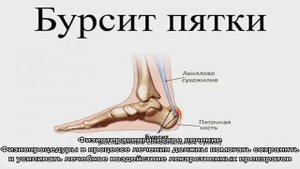 Пяточный бурсит