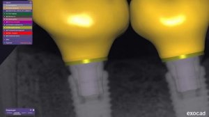 Копия видео "#STOMATALK №2. Правильный профиль прорезывания для ортопедов и зубных техников."