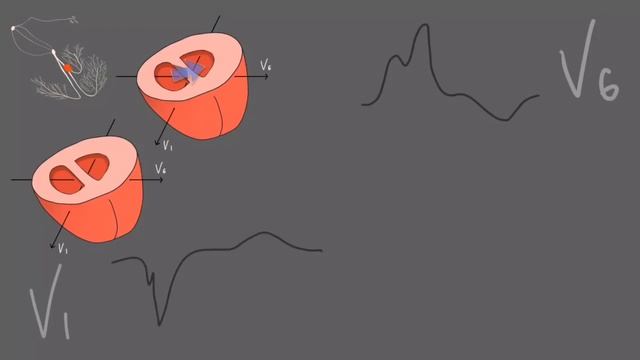Блокада левой ножки пучка Гиса. смотреть онлайн