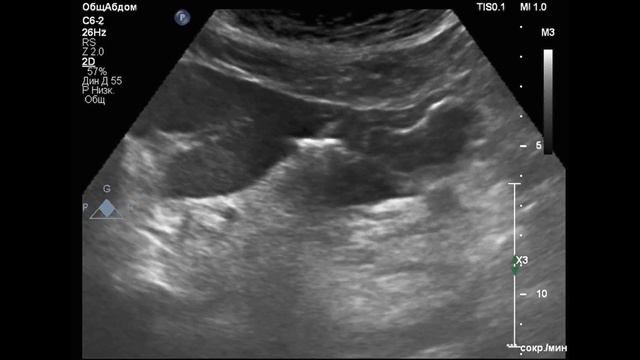 Перфорация опухоли желудка (разбор с комментариями) смотреть онлайн