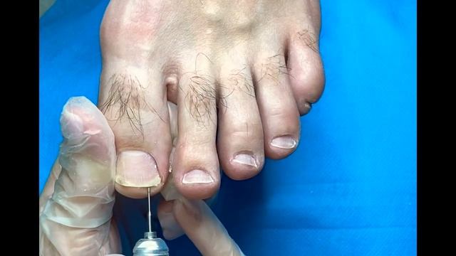 Подногтевой мозоль в педикюре ?убираем безопасной фрезой ? #педикюр смотреть онлайн