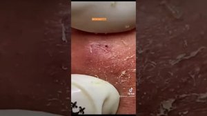 Чистка носа от чёрных точек