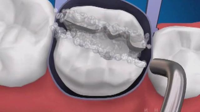 Пломбирование зуба композитом смотреть онлайн