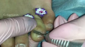 ►УЖАСНЫЙ Педикюр. ВРОСШИЙ НОГОТЬ.ПРЕОБРАЖЕНИЕ ? НЕ ДЛЯ СЛАБОНЕРВНЫХ.? Педикюр От и До. Педикюр дома