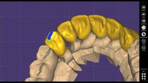 моделировка  ПММА в экзокад.зубы коронки виниры PMMA EXOCAD
