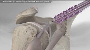 Proximal Biceps Repair Using SwiveLock® Tenodesis System