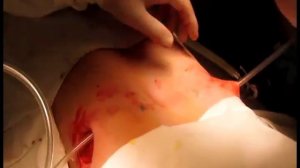 Воронкообразная грудная клетка и её лечение