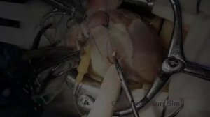 Видео 5 2 3 Ушивание  раны сердца