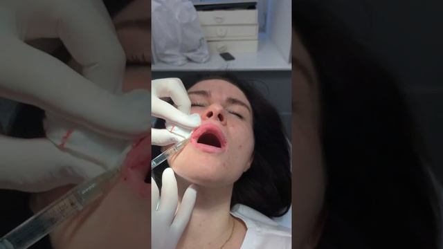 Увеличение верхней губы Ювидерм 30 смотреть онлайн