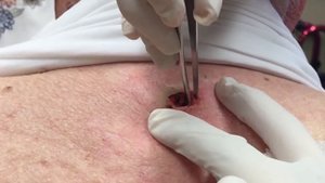 "The Award For The Biggest Blackhead" & A Juicy Cyst | Dr. Pimple Popper: This is Zit