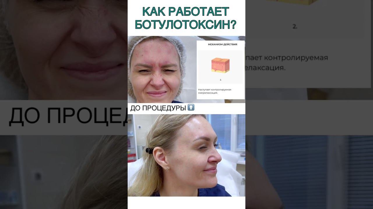 Миотокс отличие от ботокса. Миотокс отличие от ботокса