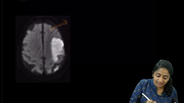 MRI in Acute Infarct - Role of Diffusion Weighted Imaging (DWI) #StrokeSeries #Diffusion_Restrictio смотреть онлайн