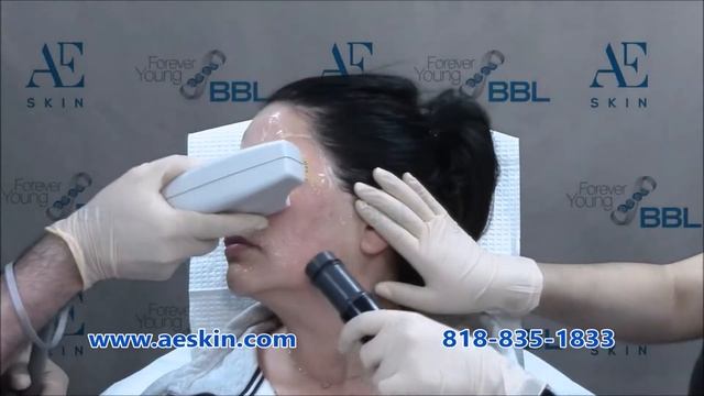 Forever Young BBL IPL Photofacial Demonstration 40 - A E Skin - Encino, CA - 818-835-1833 смотреть онлайн