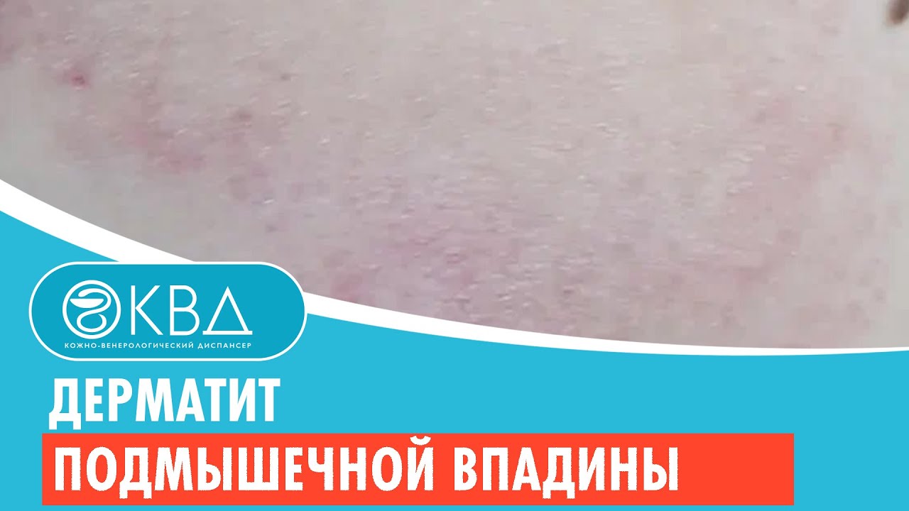 ? Дерматит подмышечной впадины. Клинический случай №300