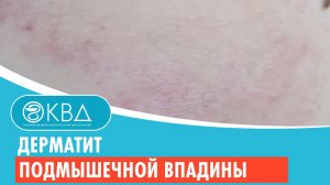 ? Дерматит подмышечной впадины. Клинический случай №300