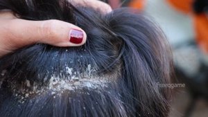 Removal Dandruff Flakes With Lice Comb | Psoriasis Flakes Scalp Easy Scratching Dandruff #1316
