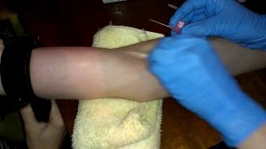 постановка кубитального катетера