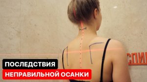 К чему может привести, если вовремя не исправить осанку?