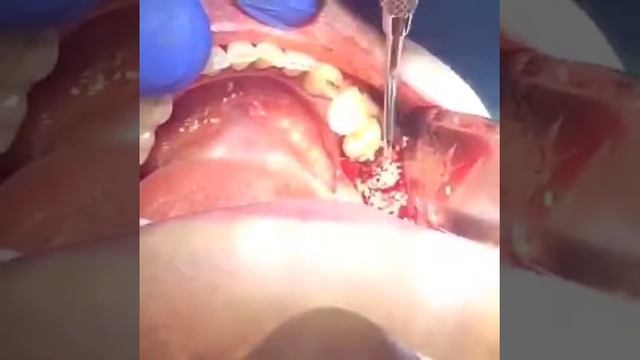 Проведение имплантации и синус-лифтинга смотреть онлайн