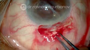 Subluxated IOL to Iris claw IOL (Замена сублюксированной заднекамерной ИОЛ на ирис-клипс ИОЛ)