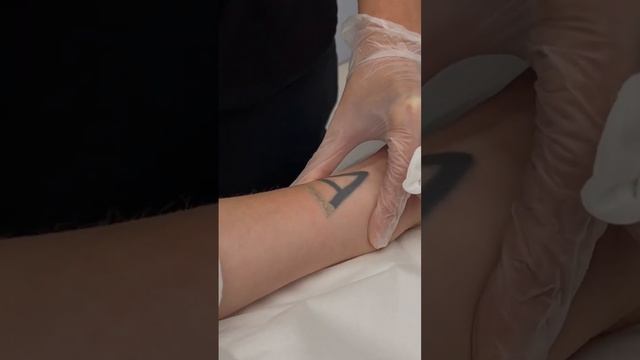 Удаление татуировки смотреть онлайн