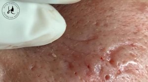 Huong Da Nang Acne Treatment #367