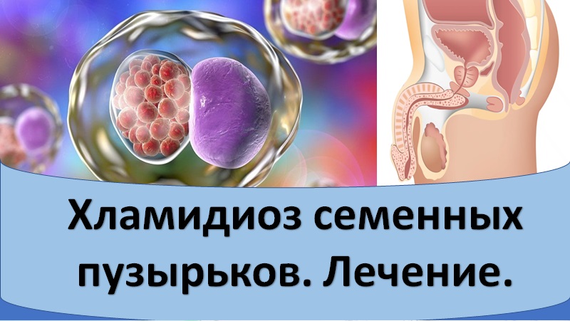 Лечение хламидиоза семенных пузырьков.