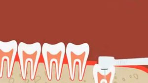 Удаление непрорезавшегося зуба мудрости