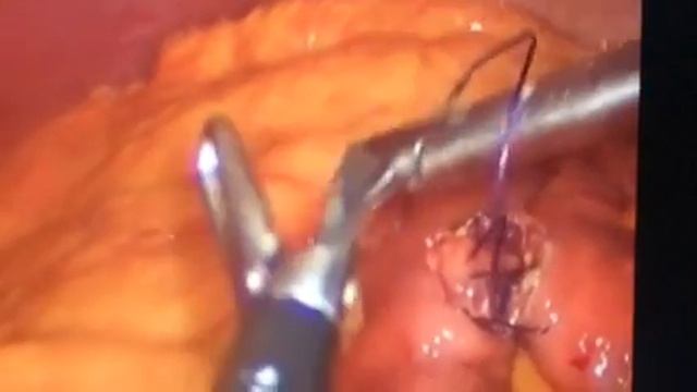 Laparoscopic intestinal suture смотреть онлайн