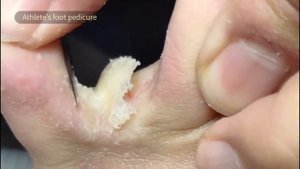 The dead skin between toes is extremely thick and must be cleaned up【Athlete’s foot pedicure】