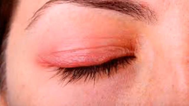 Как вылечить конъюктивит