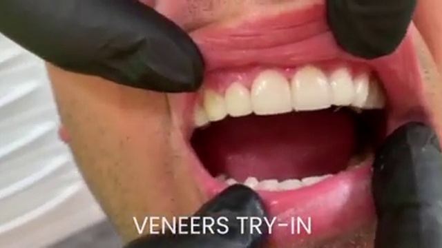 Proba gornjih 10 porculanskih ljuskica - Dental Estetic Studio, dr.T.Knego смотреть онлайн