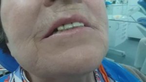 Частичный сьемный протез на нижнюю верхнюю челюсть. 13.05.2019.