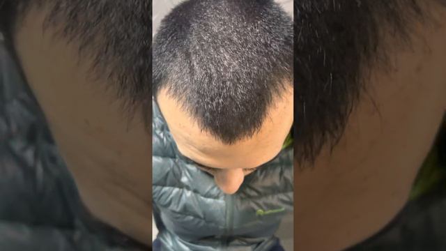 Использование генеролона 5% от облысения спустя 9 дней смотреть онлайн