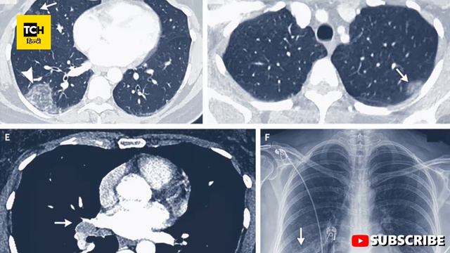Cancer From CT Scan Dr.Randeep Guleria|| No need to Worried About CT Scan says IRIA || Covid19 смотреть онлайн