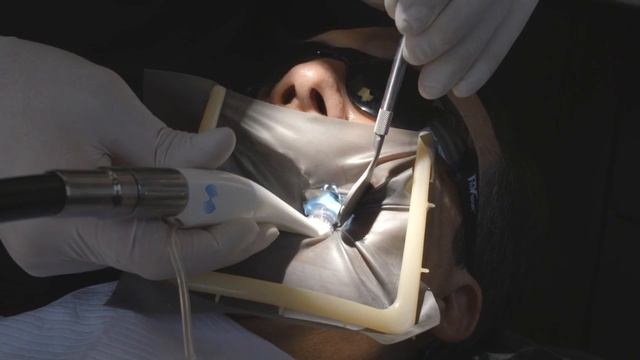 GentleWave Procedure: Today's Alternative to Standard Root Canal Treatment смотреть онлайн