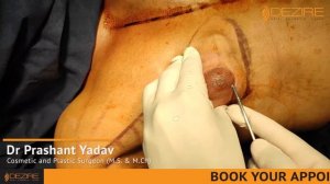 Say Goodbye to Gynecomastia !! VASER Liposuction & Gland Removal