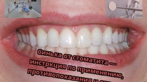 Синька от стоматита — инстркция по применению, противопоказания и отзывы