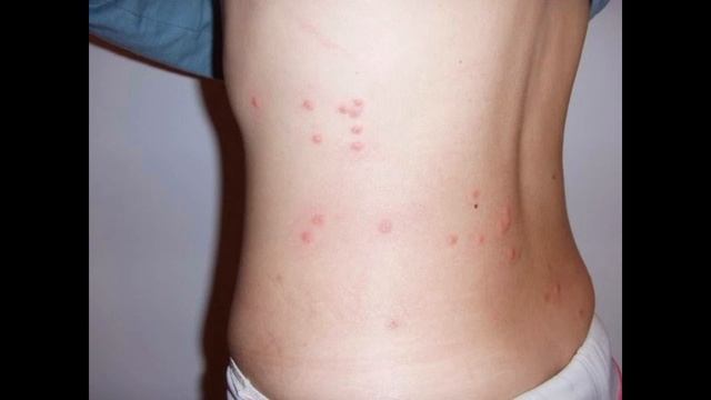 постельные клопы как выглядят укусы